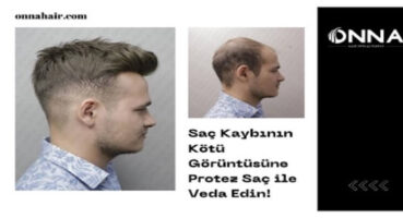 Saç Kaybının Kötü Görüntüsüne Protez Saç ile Veda Edin!