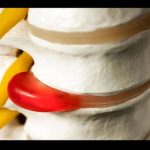 Bel Fıtığı Ameliyatı: Hangi Yöntem Daha İyi?