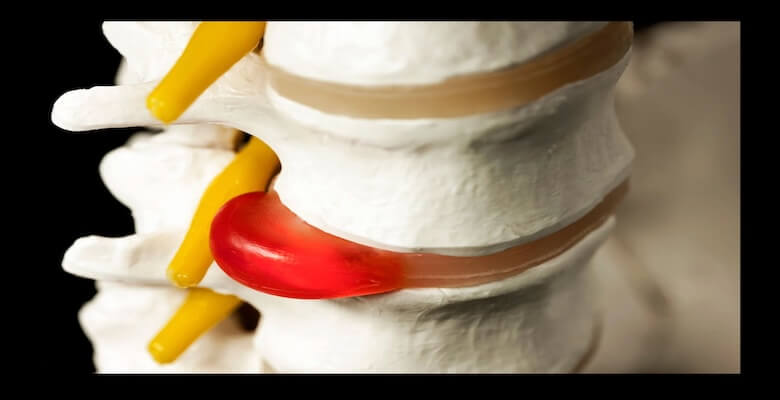 Bel Fıtığı Ameliyatı: Hangi Yöntem Daha İyi?